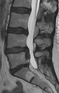 Lumbar disc herniations 