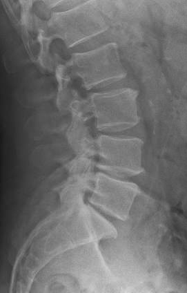 Healthy spine on x-ray
